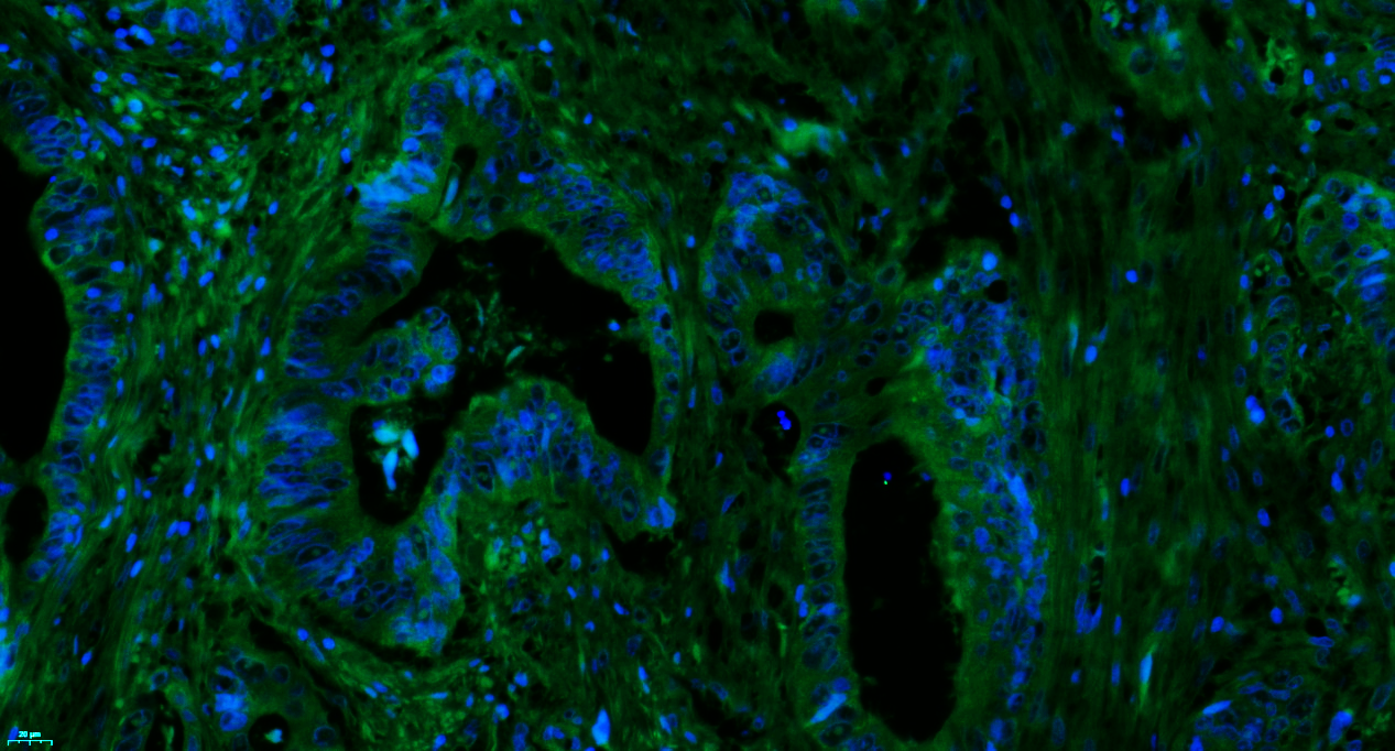 Paraformaldehyde-fixed, paraffin embedded Human rectal cancer; Antigen retrieval by boiling in sodium citrate buffer (pH6.0) for 15min; Blocking buffer (normal goat serum) at 37°C for 30min; Antibody incubation with Complement C3d fragment Polyclonal Antibody, Unconjugated (bs-4877R) at 1:100 overnight at 4°C, followed by a conjugated Goat Anti-Rabbit IgG antibody (bs-0295G-FITC) for 90 minutes, and DAPI for nuclei staining.