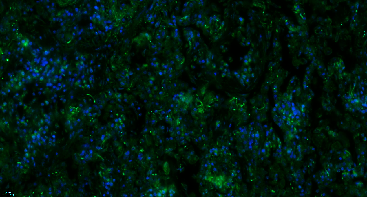 Paraformaldehyde-fixed, paraffin embedded Human lung cancer; Antigen retrieval by boiling in sodium citrate buffer (pH6.0) for 15min; Blocking buffer (normal goat serum) at 37°C for 30min; Antibody incubation with Complement C3d fragment Polyclonal Antibody, Unconjugated (bs-4877R) at 1:100 overnight at 4°C, followed by a conjugated Goat Anti-Rabbit IgG antibody (bs-0295G-FITC) for 90 minutes, and DAPI for nuclei staining.