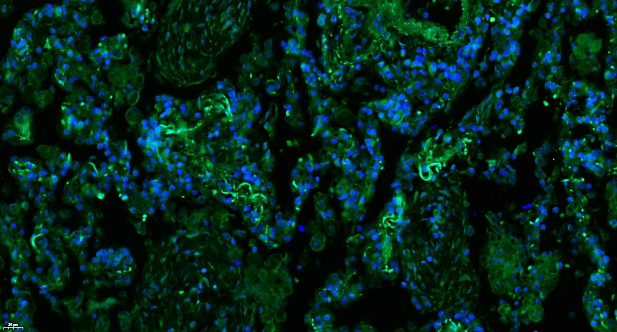 Paraformaldehyde-fixed, paraffin embedded Human lung cancer; Antigen retrieval by boiling in sodium citrate buffer (pH6.0) for 15min; Blocking buffer (normal goat serum) at 37°C for 30min; Antibody incubation with Properdin Polyclonal Antibody, Unconjugated (bs-8306R) at 1:100 overnight at 4°C, followed by a conjugated Goat Anti-Rabbit IgG antibody (bs-0295G-FITC) for 90 minutes, and DAPI for nuclei staining.
