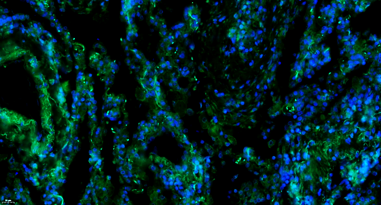 Paraformaldehyde-fixed, paraffin embedded Human lung cancer; Antigen retrieval by boiling in sodium citrate buffer (pH6.0) for 15min; Blocking buffer (normal goat serum) at 37°C for 30min; Antibody incubation with Factor H Polyclonal Antibody, Unconjugated (bs-9525R) at 1:100 overnight at 4°C, followed by a conjugated Goat Anti-Rabbit IgG antibody (bs-0295G-FITC) for 90 minutes, and DAPI for nuclei staining.