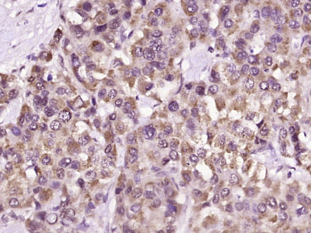 Paraformaldehyde-fixed, paraffin embedded Human liver cancer; Antigen retrieval by boiling in sodium citrate buffer (pH6.0) for 15min; Block endogenous peroxidase by 3% hydrogen peroxide for 20 minutes; Blocking buffer (normal goat serum) at 37°C for 30min; Antibody incubation with _x000D_ IFNAR1(Ser535+Ser538) Polyclonal Antibody, Unconjugated (bs-5457R) at 1:400 overnight at 4°C, DAB staining. Paraformaldehyde-fixed, paraffin embedded Human liver cancer; Antigen retrieval by boiling in sodium citrate buffer (pH6.0) for 15min; Block endogenous peroxidase by 3% hydrogen peroxide for 20 minutes; Blocking buffer (normal goat serum) at 37°C for 30min; Antibody incubation with _x000D_ IFNAR1(Ser535+Ser538) Polyclonal Antibody, Unconjugated (bs-5457R) at 1:400 overnight at 4°C, DAB staining.