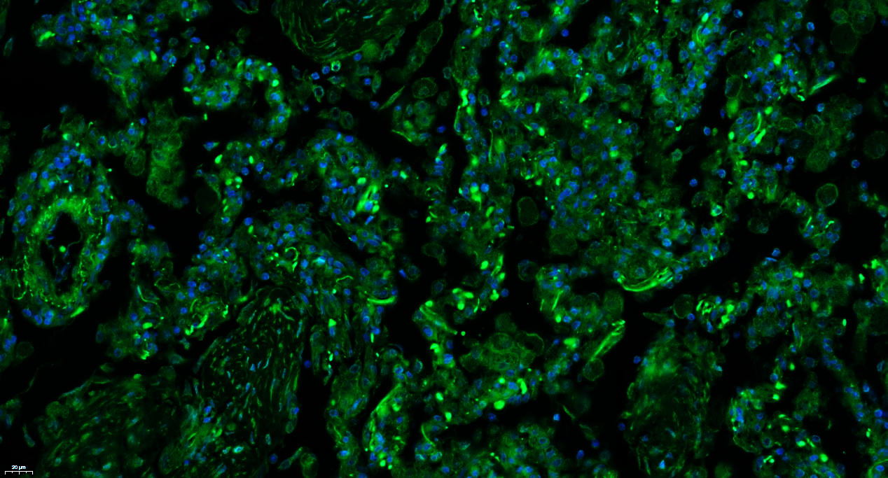 Paraformaldehyde-fixed, paraffin embedded Human Lung Cancer; Antigen retrieval by boiling in sodium citrate buffer (pH6.0) for 15min; Blocking buffer (normal goat serum) at 37°C for 30min; Antibody incubation with CD133 Polyclonal Antibody, Unconjugated (bs-4770R) at 1:100 overnight at 4°C, followed by a conjugated Goat Anti-Rabbit IgG antibody (bs-0295G-FITC) for 90 minutes, and DAPI for nuclei staining. Paraformaldehyde-fixed, paraffin embedded Human Lung Cancer; Antigen retrieval by boiling in sodium citrate buffer (pH6.0) for 15min; Blocking buffer (normal goat serum) at 37°C for 30min; Antibody incubation with CD133 Polyclonal Antibody, Unconjugated (bs-4770R) at 1:100 overnight at 4°C, followed by a conjugated Goat Anti-Rabbit IgG antibody (bs-0295G-FITC) for 90 minutes, and DAPI for nuclei staining.
