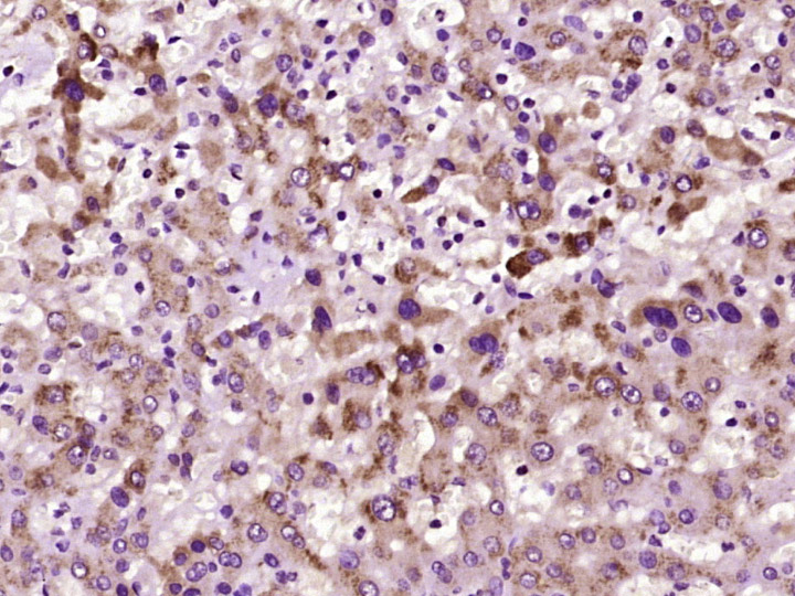 Paraformaldehyde-fixed, paraffin embedded Human liver; Antigen retrieval by boiling in sodium citrate buffer (pH6.0) for 15min; Block endogenous peroxidase by 3% hydrogen peroxide for 20 minutes; Blocking buffer (normal goat serum) at 37°C for 30min; Antibody incubation with GST1 Polyclonal Antibody, Unconjugated (bs-0663R) at 1:400 overnight at 4°C, DAB staining.