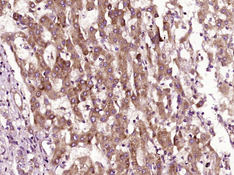 Paraformaldehyde-fixed, paraffin embedded Human liver cancer; Antigen retrieval by boiling in sodium citrate buffer (pH6.0) for 15min; Block endogenous peroxidase by 3% hydrogen peroxide for 20 minutes; Blocking buffer (normal goat serum) at 37°C for 30min; Antibody incubation with GST1 Polyclonal Antibody, Unconjugated (bs-0663R) at 1:400 overnight at 4°C, DAB staining.