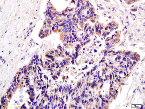 Formalin-fixed and paraffin embedded human colon carcinoma labeled with Anti-XAGE2 Polyclonal Antibody, Unconjugated (bs-7017R) at 1:200 followed by conjugation to the secondary antibody and DAB staining.