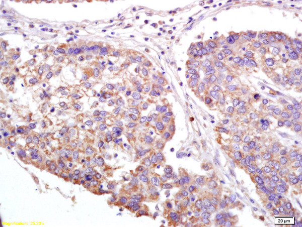 Formalin-fixed and paraffin embedded human lung carcinoma labeled with Anti-XAGE2 Polyclonal Antibody, Unconjugated (bs-7017R) at 1:200 followed by conjugation to the secondary antibody and DAB staining. Formalin-fixed and paraffin embedded human lung carcinoma labeled with Anti-XAGE2 Polyclonal Antibody, Unconjugated (bs-7017R) at 1:200 followed by conjugation to the secondary antibody and DAB staining.