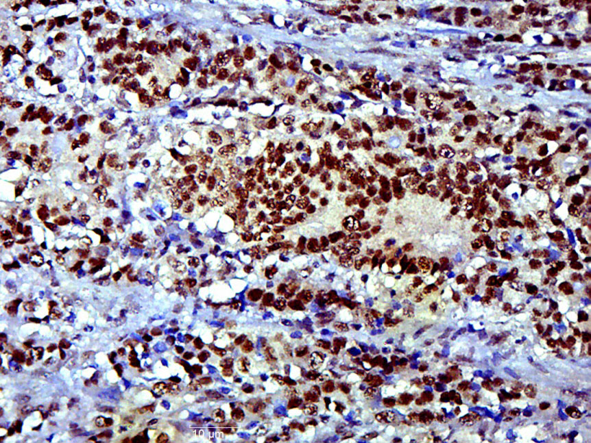Paraformaldehyde-fixed, paraffin embedded Human colon cancer; Antigen retrieval by boiling in sodium citrate buffer (pH6.0) for 15min; Block endogenous peroxidase by 3% hydrogen peroxide for 20 minutes; Blocking buffer (normal goat serum) at 37°C for 30min; Antibody incubation with SOX9 Polyclonal Antibody, Unconjugated (bs-10725R) at 1:400 overnight at 4°C, DAB staining.