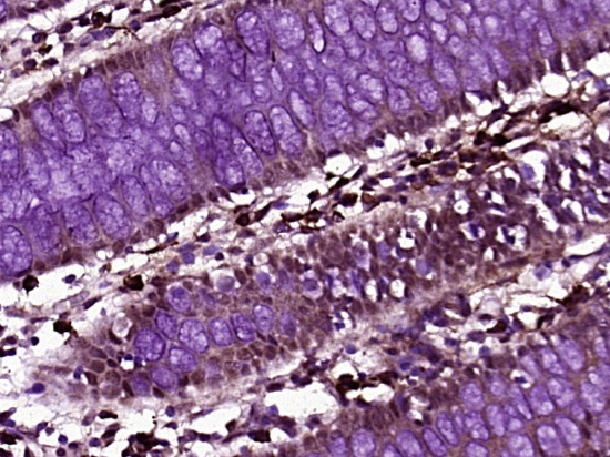 Paraformaldehyde-fixed, paraffin embedded Human colon cancer; Antigen retrieval by boiling in sodium citrate buffer (pH6.0) for 15min; Block endogenous peroxidase by 3% hydrogen peroxide for 20 minutes; Blocking buffer (normal goat serum) at 37°C for 30min; Antibody incubation with ZNF197 Polyclonal Antibody, Unconjugated (bs-12797R) at 1:400 overnight at 4°C, DAB staining.
