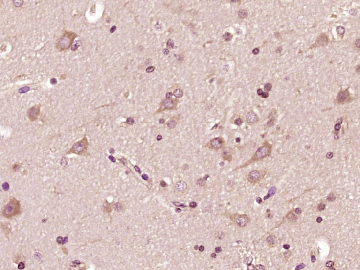 Paraformaldehyde-fixed, paraffin embedded Human brain glioma; Antigen retrieval by boiling in sodium citrate buffer (pH6.0) for 15min; Block endogenous peroxidase by 3% hydrogen peroxide for 20 minutes; Blocking buffer (normal goat serum) at 37°C for 30min; Antibody incubation with STK11IP Polyclonal Antibody, Unconjugated (bs-12827R) at 1:400 overnight at 4°C, DAB staining.