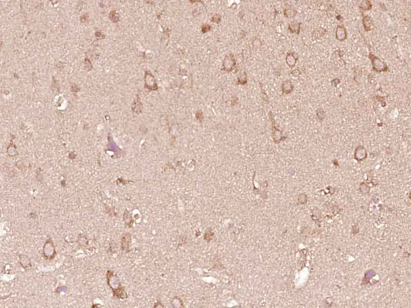 Paraformaldehyde-fixed, paraffin embedded Human brain glioma; Antigen retrieval by boiling in sodium citrate buffer (pH6.0) for 15min; Block endogenous peroxidase by 3% hydrogen peroxide for 20 minutes; Blocking buffer (normal goat serum) at 37°C for 30min; Antibody incubation with CRB1 Polyclonal Antibody, Unconjugated (bs-14045R) at 1:400 overnight at 4°C, DAB staining.