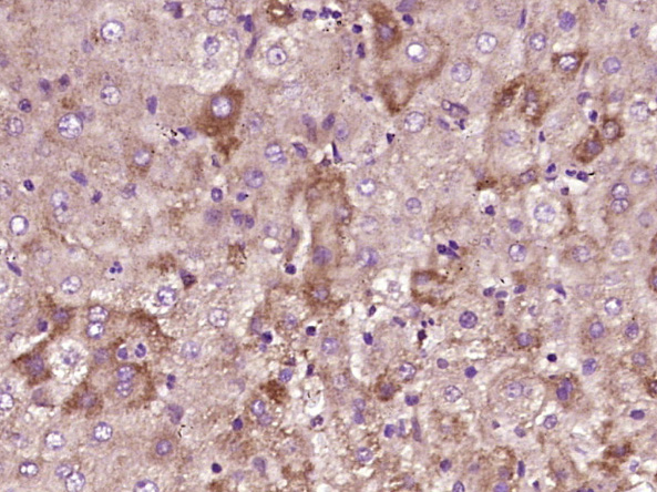 Paraformaldehyde-fixed, paraffin embedded Human liver cancer; Antigen retrieval by boiling in sodium citrate buffer (pH6.0) for 15min; Block endogenous peroxidase by 3% hydrogen peroxide for 20 minutes; Blocking buffer (normal goat serum) at 37°C for 30min; Antibody incubation with CRISP10 Polyclonal Antibody, Unconjugated (bs-14060R) at 1:400 overnight at 4°C, DAB staining.