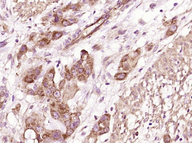 Paraformaldehyde-fixed, paraffin embedded Human stomach cancer; Antigen retrieval by boiling in sodium citrate buffer (pH6.0) for 15min; Block endogenous peroxidase by 3% hydrogen peroxide for 20 minutes; Blocking buffer (normal goat serum) at 37°C for 30min; Antibody incubation with CRISP10 Polyclonal Antibody, Unconjugated (bs-14060R) at 1:400 overnight at 4°C, DAB staining.