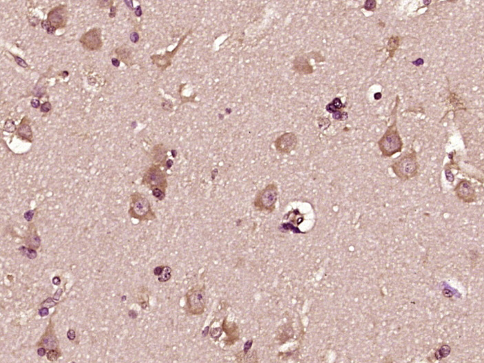 Paraformaldehyde-fixed, paraffin embedded Human brain glioma; Antigen retrieval by boiling in sodium citrate buffer (pH6.0) for 15min; Block endogenous peroxidase by 3% hydrogen peroxide for 20 minutes; Blocking buffer (normal goat serum) at 37°C for 30min; Antibody incubation with DHI1L Polyclonal Antibody, Unconjugated (bs-14303R) at 1:400 overnight at 4°C, DAB staining.