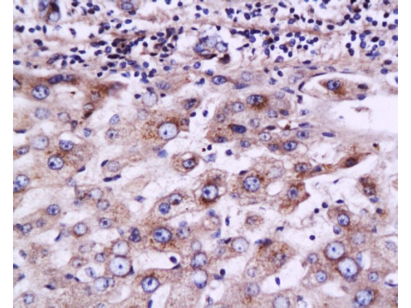 Formalin-fixed and paraffin embedded human liver carcinoma labeled with Anti-MRP2 Polyclonal Antibody, Unconjugated (bs-1092R) at 1:200 followed by conjugation to the secondary antibody and DAB staining.