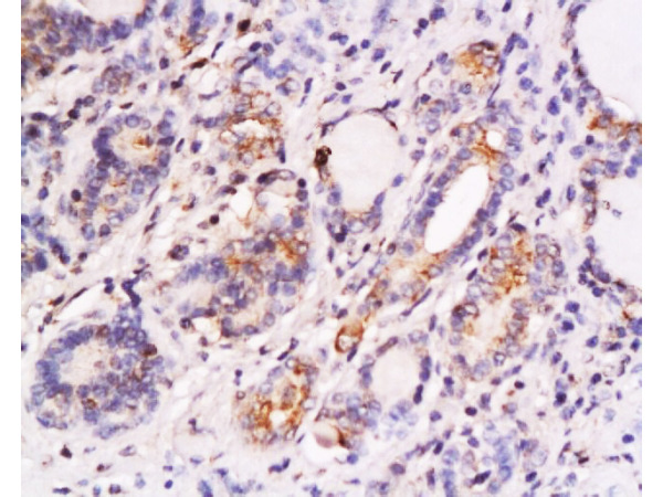 Formalin-fixed and paraffin embedded human thyroid carcinoma labeled with Anti-SKP2\/skp2 p45 Polyclonal Antibody, Unconjugated (bs-1096R) at 1:200 followed by conjugation to the secondary antibody and DAB staining.