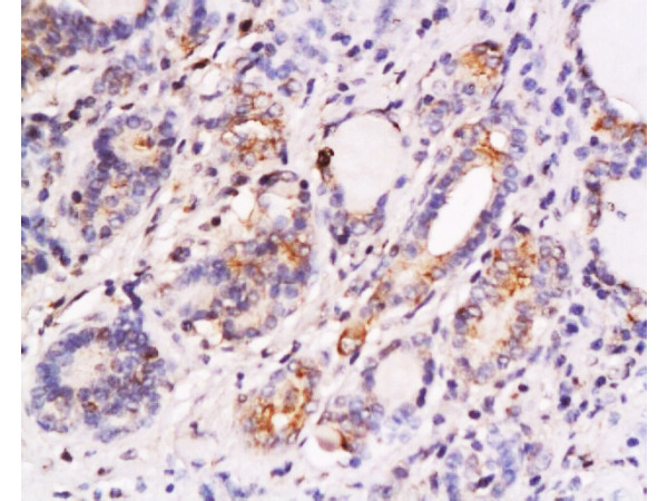 Formalin-fixed and paraffin embedded human thyroid carcinoma labeled with Anti-SKP2/skp2 p45 Polyclonal Antibody, Unconjugated (bs-1096R) at 1:200 followed by conjugation to the secondary antibody and DAB staining.