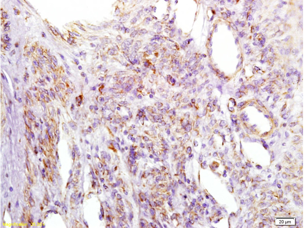 Formalin-fixed and paraffin embedded human cervical carcinoma labeled with Anti-IGFBP2 Polyclonal Antibody, Unconjugated (bs-1108R) at 1:200 followed by conjugation to the secondary antibody and DAB staining.