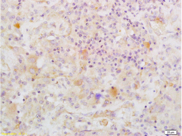 Formalin-fixed and paraffin embedded human glioma labeled with Anti-IGFBP2 Polyclonal Antibody, Unconjugated (bs-1108R) at 1:200 followed by conjugation to the secondary antibody and DAB staining.