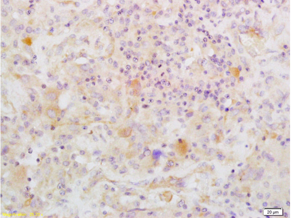 Formalin-fixed and paraffin embedded human glioma labeled with Anti-IGFBP2 Polyclonal Antibody, Unconjugated (bs-1108R) at 1:200 followed by conjugation to the secondary antibody and DAB staining.