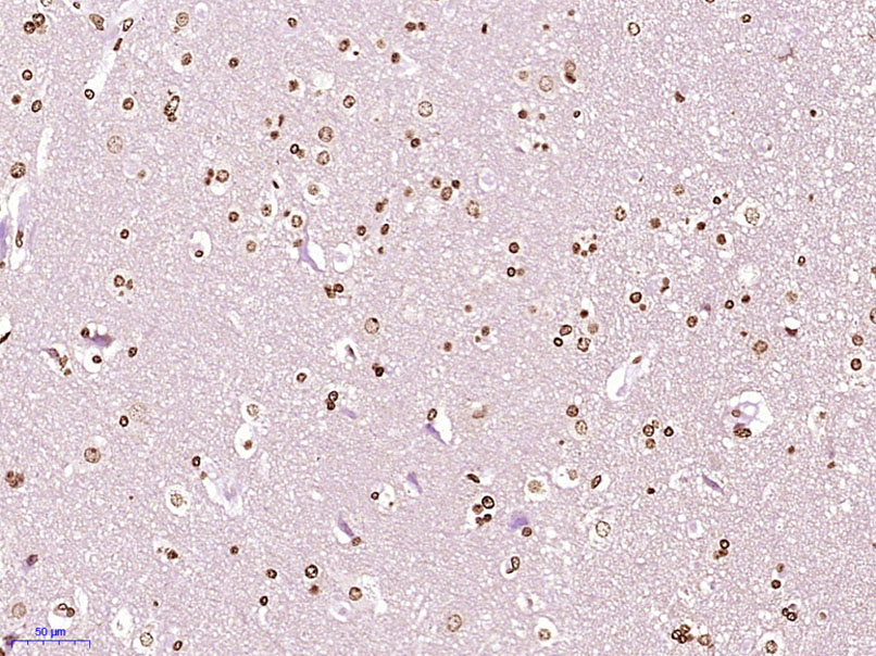 Paraformaldehyde-fixed, paraffin embedded Human brain glioma; Antigen retrieval by boiling in sodium citrate buffer (pH6.0) for 15min; Block endogenous peroxidase by 3% hydrogen peroxide for 20 minutes; Blocking buffer (normal goat serum) at 37°C for 30min; Antibody incubation with ZFPL1 Polyclonal Antibody, Unconjugated (bs-19136R) at 1:400 overnight at 4°C, DAB staining.