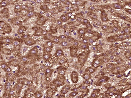 Paraformaldehyde-fixed, paraffin embedded Human liver cancer; Antigen retrieval by boiling in sodium citrate buffer (pH6.0) for 15min; Block endogenous peroxidase by 3% hydrogen peroxide for 20 minutes; Blocking buffer (normal goat serum) at 37°C for 30min; Antibody incubation with PTPD1 Polyclonal Antibody, Unconjugated (bs-19587R) at 1:400 overnight at 4°C, DAB staining.