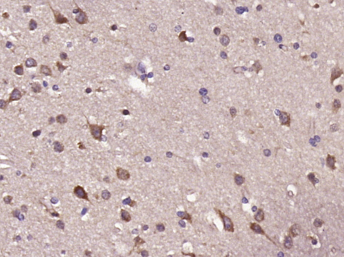 Paraformaldehyde-fixed, paraffin embedded Human brain glioma; Antigen retrieval by boiling in sodium citrate buffer (pH6.0) for 15min; Block endogenous peroxidase by 3% hydrogen peroxide for 20 minutes; Blocking buffer (normal goat serum) at 37°C for 30min; Antibody incubation with Dopamine D2 Receptor Polyclonal Antibody, Unconjugated (bs-20729R) at 1:400 overnight at 4°C, DAB staining.