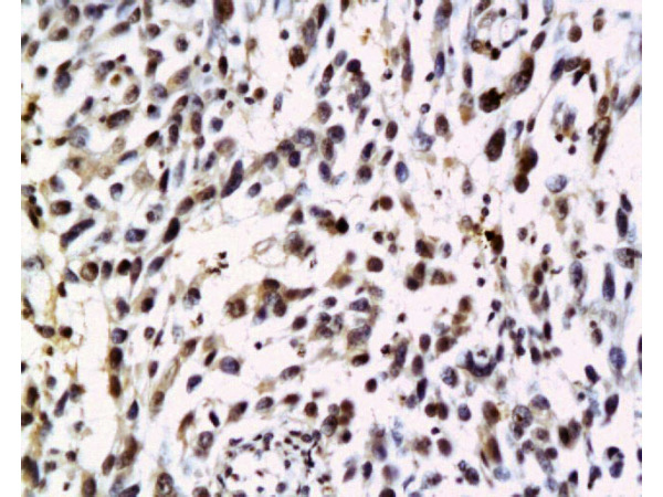 Formalin-fixed and paraffin embedded human cervical carcinoma labeled with Anti-NRAS Polyclonal Antibody, Unconjugated (bs-1146R) at 1:200 followed by conjugation to the secondary antibody and DAB staining.