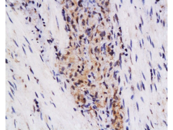 Formalin-fixed and paraffin embedded human colon carcinoma labeled with Anti-SynCAM/TSLC1 Polyclonal Antibody, Unconjugated (bs-1147R) at 1:200 followed by conjugation to the secondary antibody and DAB staining.