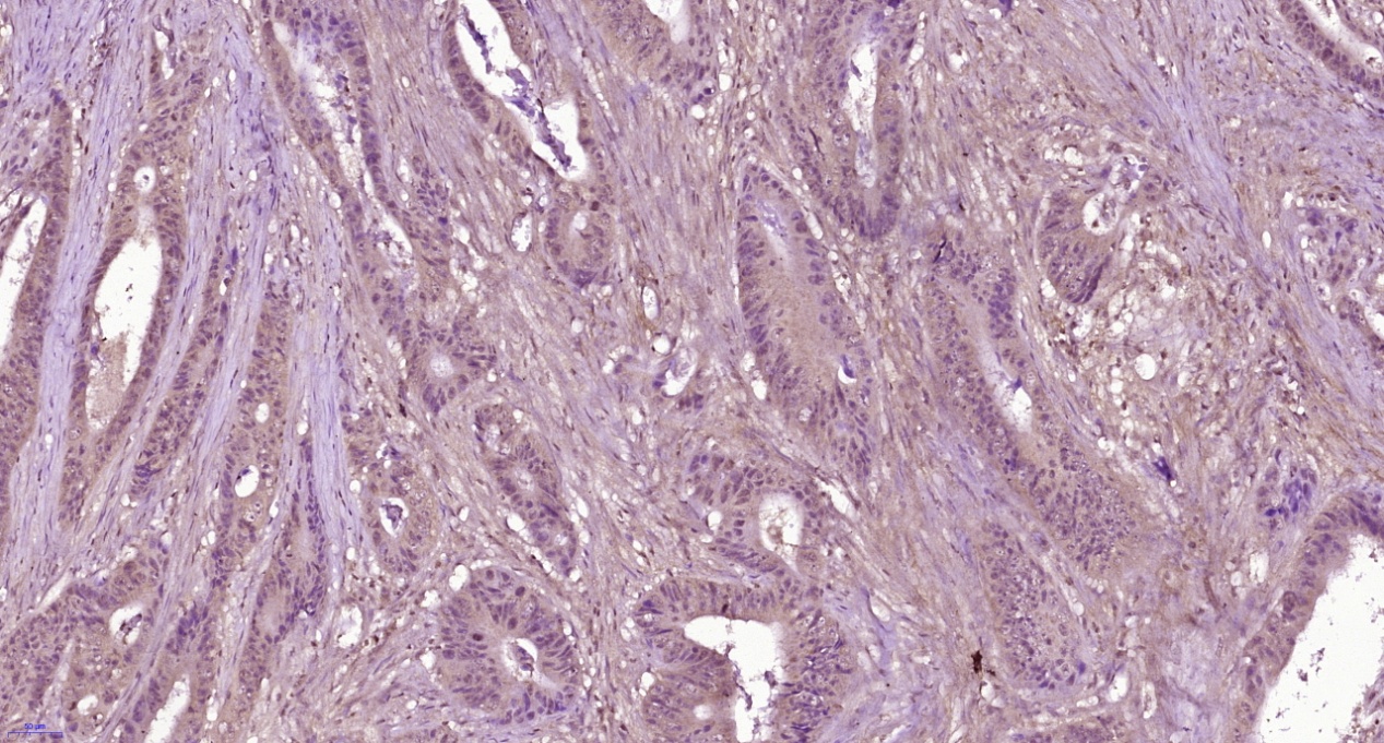Paraformaldehyde-fixed, paraffin embedded Human rectal cancer; Antigen retrieval by boiling in sodium citrate buffer (pH6.0) for 15min; Block endogenous peroxidase by 3% hydrogen peroxide for 20 minutes; Blocking buffer (normal goat serum) at 37°C for 30min; Antibody incubation with C5b-9 Polyclonal Antibody, Unconjugated (bs-2673R) at 1:100 overnight at 4°C, followed by secondary and DAB staining.