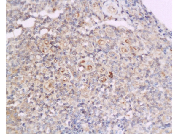 Formalin-fixed and paraffin embedded human flat moss tinea tissue labeled with Anti-Cyclin D2 Polyclonal Antibody, Unconjugated (bs-1148R) at 1:200 followed by conjugation to the secondary antibody and DAB staining
