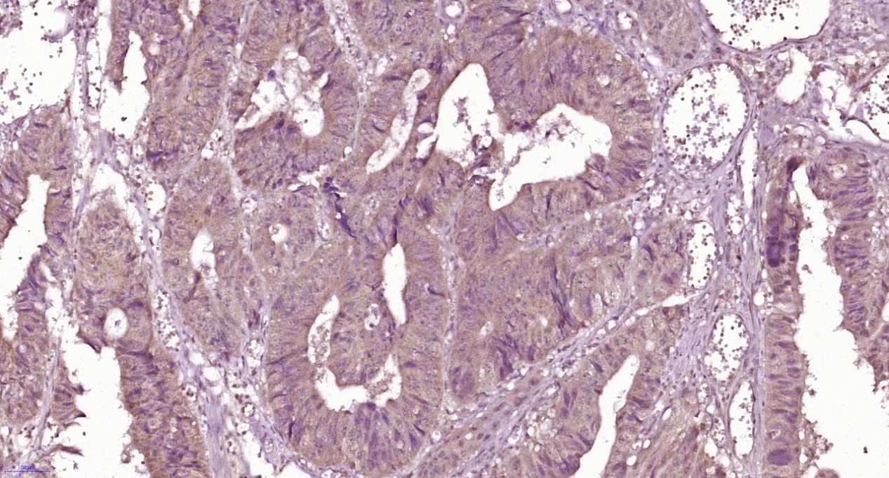 Paraformaldehyde-fixed, paraffin embedded Human rectal cancer; Antigen retrieval by boiling in sodium citrate buffer (pH6.0) for 15min; Block endogenous peroxidase by 3% hydrogen peroxide for 20 minutes; Blocking buffer (normal goat serum) at 37°C for 30min; Antibody incubation with Properdin Polyclonal Antibody, Unconjugated (bs-8306R) at 1:100 overnight at 4°C, followed by secondary and DAB staining.