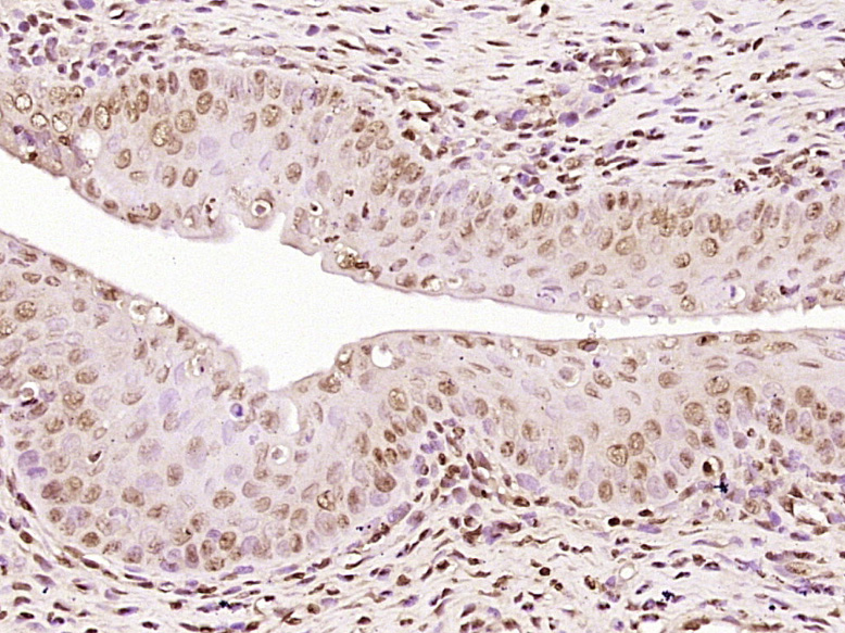 Paraformaldehyde-fixed, paraffin embedded Rat uterus; Antigen retrieval by boiling in sodium citrate buffer (pH6.0) for 15min; Block endogenous peroxidase by 3% hydrogen peroxide for 20 minutes; Blocking buffer (normal goat serum) at 37°C for 30min; Antibody incubation with Progesterone Receptor Polyclonal Antibody, Unconjugated (bs-23376R) at 1:400 overnight at 4°C, DAB staining. Paraformaldehyde-fixed, paraffin embedded Rat uterus; Antigen retrieval by boiling in sodium citrate buffer (pH6.0) for 15min; Block endogenous peroxidase by 3% hydrogen peroxide for 20 minutes; Blocking buffer (normal goat serum) at 37°C for 30min; Antibody incubation with Progesterone Receptor Polyclonal Antibody, Unconjugated (bs-23376R) at 1:400 overnight at 4°C, DAB staining.