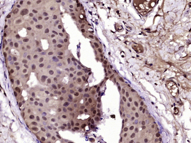 Paraformaldehyde-fixed, paraffin embedded Human breast cancer; Antigen retrieval by boiling in sodium citrate buffer (pH6.0) for 15min; Block endogenous peroxidase by 3% hydrogen peroxide for 20 minutes; Blocking buffer (normal goat serum) at 37°C for 30min; Antibody incubation with Progesterone Receptor Polyclonal Antibody, Unconjugated (bs-23376R) at 1:400 overnight at 4°C, DAB staining.
