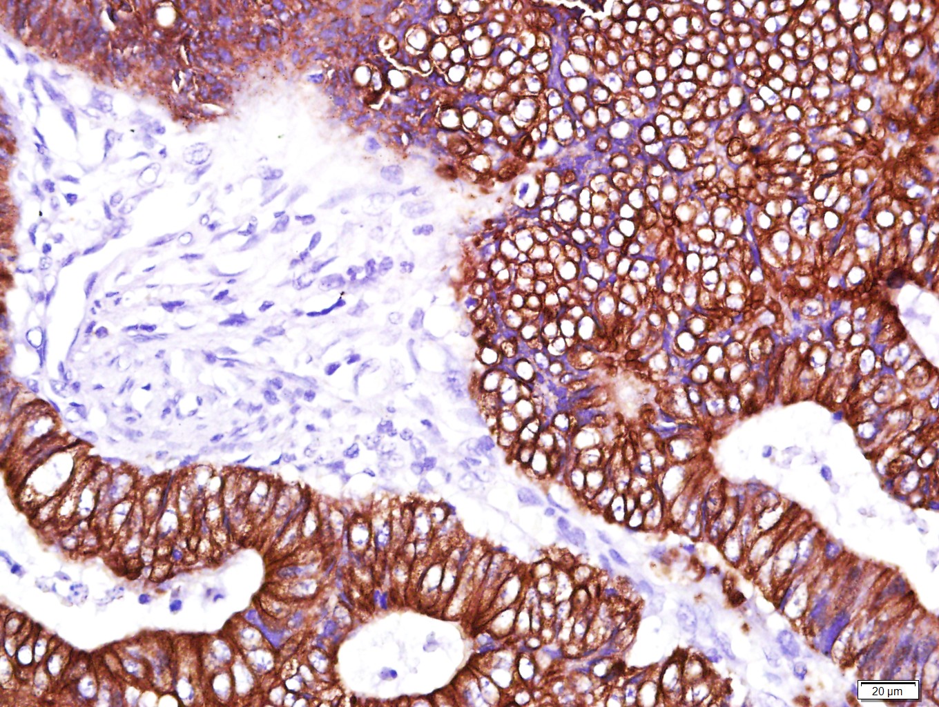 Paraformaldehyde-fixed, paraffin embedded Human colon cancer; Antigen retrieval by boiling in sodium citrate buffer (pH6.0) for 15min; Block endogenous peroxidase by 3% hydrogen peroxide for 20 minutes; Blocking buffer (normal goat serum) at 37°C for 30min; Antibody incubation with Cytokeratin 8 Monoclonal Antibody, Unconjugated (bsm-33061M) at 1:400 overnight at 4°C, DAB staining.