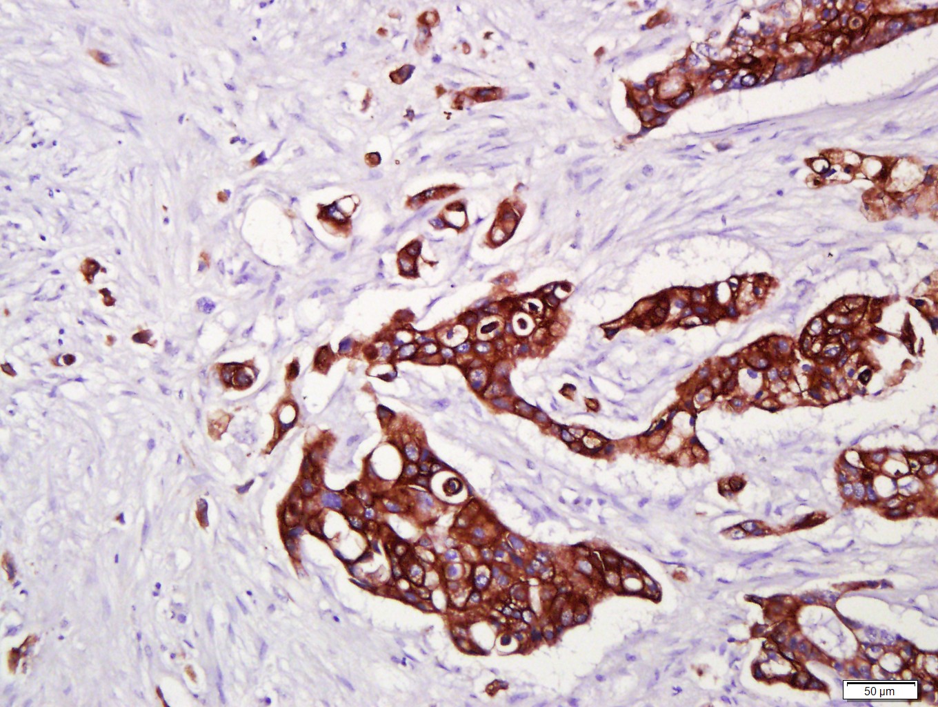 Paraformaldehyde-fixed, paraffin embedded Human cervical cancer; Antigen retrieval by boiling in sodium citrate buffer (pH6.0) for 15min; Block endogenous peroxidase by 3% hydrogen peroxide for 20 minutes; Blocking buffer (normal goat serum) at 37°C for 30min; Antibody incubation with CK16 Monoclonal Antibody, Unconjugated (bsm-33062M) at 1:400 overnight at 4°C, DAB staining.