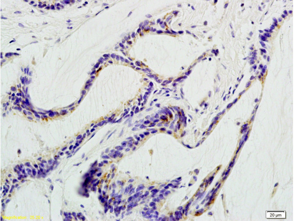 Formalin-fixed and paraffin embedded human colon carcinoma labeled with Anti-beta Defensin 1 Polyclonal Antibody, Unconjugated (bs-1163R) at 1:200 followed by conjugation to the secondary antibody and DAB staining.