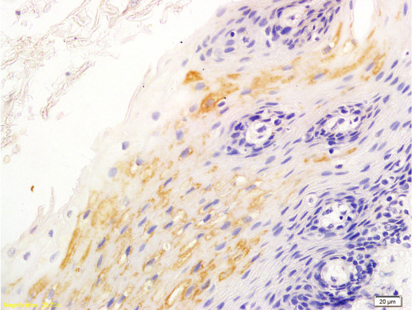Formalin-fixed and paraffin embedded human esophageal cancer labeled with Anti-\u03b2-catenin\/Catenin \u03b2 Polyclonal Antibody, Unconjugated (bs-1165R) at 1:200 followed by conjugation to the secondary antibody and DAB staining.