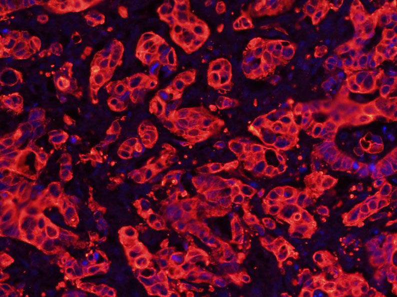 Paraformaldehyde-fixed, paraffin embedded Human cervical cancer; Antigen retrieval by boiling in sodium citrate buffer (pH6.0) for 15min; Blocking buffer (normal goat serum) at 37°C for 30min; Antibody incubation with Cytokeratin 8 Monoclonal Antibody, Unconjugated (bsm-33061M) at 1:500 overnight at 4°C, followed by Goat Anti-Mouse IgG (H+L) Cy3 conjugated secondary antibody. DAPI staining of the nucleus was done and then detected.
