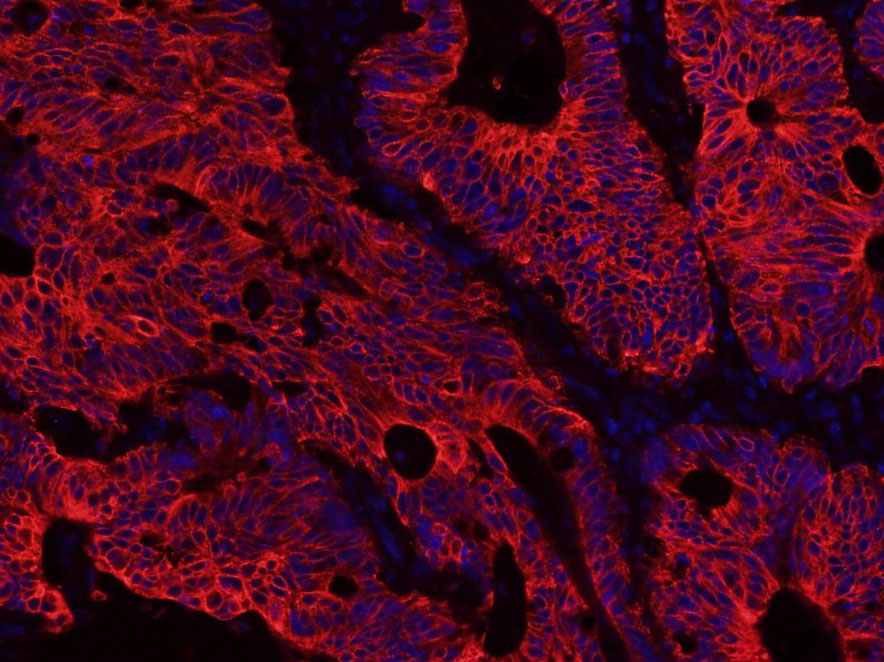 Paraformaldehyde-fixed, paraffin embedded Human colon cancer; Antigen retrieval by boiling in sodium citrate buffer (pH6.0) for 15min; Blocking buffer (normal goat serum) at 37°C for 30min; Antibody incubation with Cytokeratin 8 Monoclonal Antibody, Unconjugated (bsm-33061M) at 1:500 overnight at 4°C, followed by Goat Anti-Mouse IgG (H+L) Cy3 conjugated secondary antibody. DAPI staining of the nucleus was done and then detected.