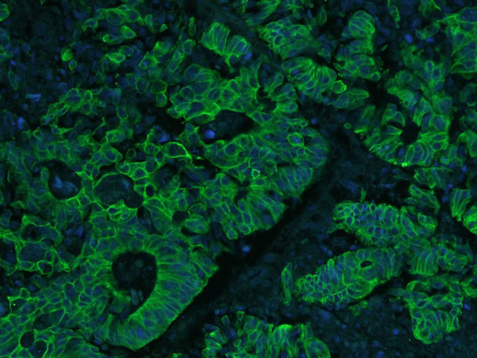 Paraformaldehyde-fixed, paraffin embedded Human stomach cancer; Antigen retrieval by boiling in sodium citrate buffer (pH6.0) for 15min; Blocking buffer (normal goat serum) at 37°C for 30min; Antibody incubation with Cytokeratin 8 Monoclonal Antibody, Unconjugated (bsm-33061M) at 1:500 overnight at 4°C, followed by Goat Anti-Mouse IgG (H+L) FITC conjugated secondary antibody. DAPI staining of the nucleus was done and then detected.