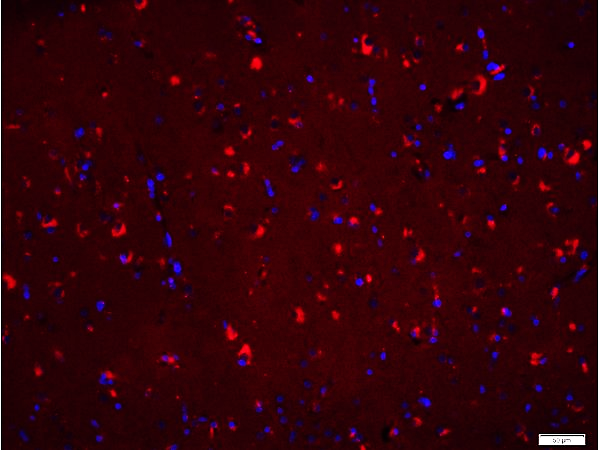 Paraformaldehyde-fixed, paraffin embedded Human brain glioma; Antigen retrieval by boiling in sodium citrate buffer (pH6.0) for 15min; Blocking buffer (normal goat serum) at 37°C for 30min; Antibody incubation with Bax Monoclonal Antibody, Unconjugated (bsm-33279M) at 1:300 overnight at 4°C, followed by Goat Anti-Mouse IgG (H+L) Cy3 conjugated secondary antibody. DAPI staining of the nucleus was done and then detected.