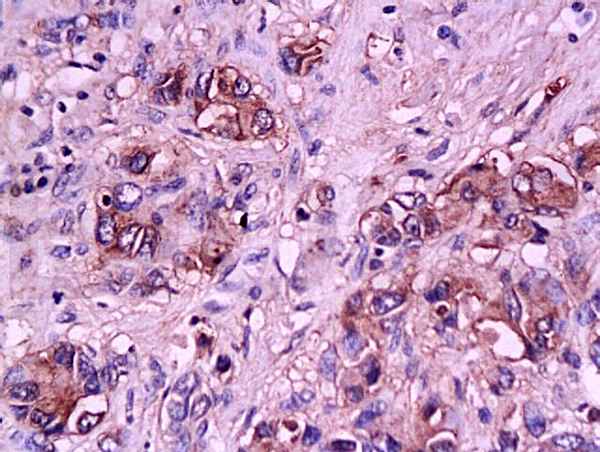 Formalin-fixed and paraffin embedded human gastric carcinoma tissue labeled with Anti-E-Selectin Polyclonal Antibody, Unconjugated(bs-1273R) at 1:200 followed by conjugation to the secondary antibody and DAB staining