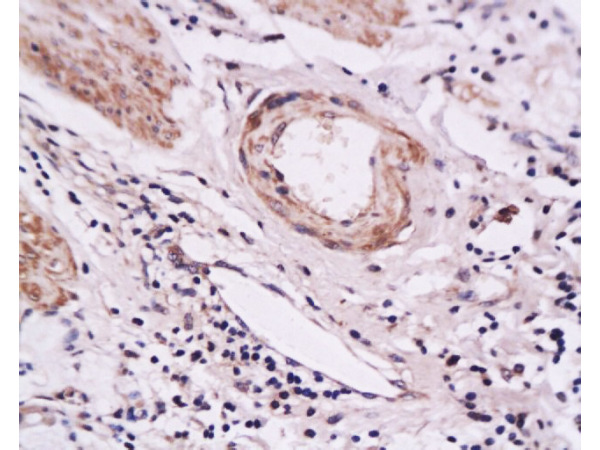 Formalin-fixed and paraffin embedded human gastric carcinoma tissue labeled with Anti-E-Selectin Polyclonal Antibody, Unconjugated(bs-1273R) at 1:200 followed by conjugation to the secondary antibody and DAB staining