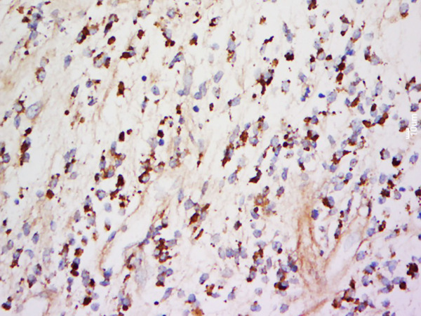 Paraformaldehyde-fixed, paraffin embedded Human Neurilemmoma; Antigen retrieval by boiling in sodium citrate buffer (pH6.0) for 15min; Block endogenous peroxidase by 3% hydrogen peroxide for 20 minutes; Blocking buffer (normal goat serum) at 37°C for 30min; Antibody incubation with ChRM2 Polyclonal Antibody, Unconjugated (bs-0236R) at 1:500 overnight at 4°C, DAB staining.