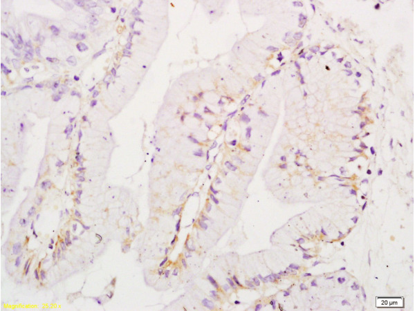 Formalin-fixed and paraffin embedded human endometrium carcinoma labeled with Anti-Ezrin Polyclonal Antibody, Unconjugated (bs-1343R) at 1:200 followed by conjugation to the secondary antibody and DAB staining.