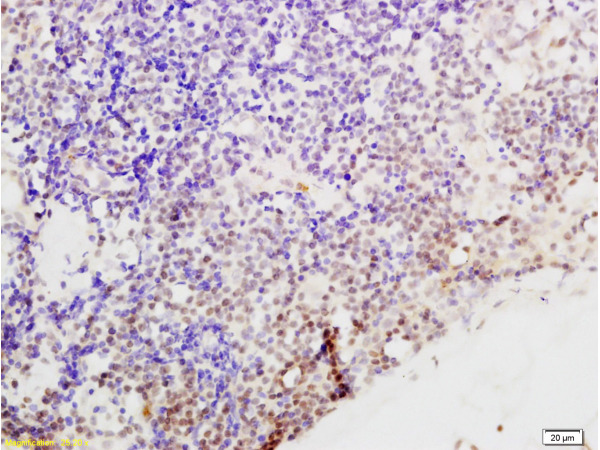 Formalin-fixed and paraffin embedded human endometrium carcinoma tissue labeled with Anti-Cyclin G Polyclonal Antibody, Unconjugated (bs-1389R) at 1:200 followed by conjugation to the secondary antibody and DAB stainin