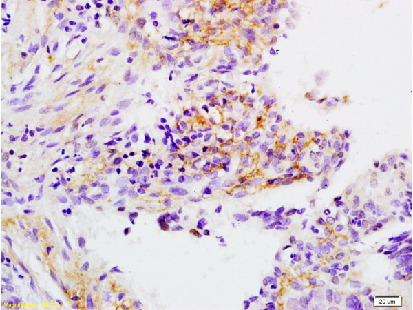 Formalin-fixed and paraffin embedded human laryngeal cancer labeled with Anti-APOH Polyclonal Antibody, Unconjugated (bs-1570R) at 1:200 followed by conjugation to the secondary antibody and DAB staining. Formalin-fixed and paraffin embedded human laryngeal cancer labeled with Anti-APOH Polyclonal Antibody, Unconjugated (bs-1570R) at 1:200 followed by conjugation to the secondary antibody and DAB staining.