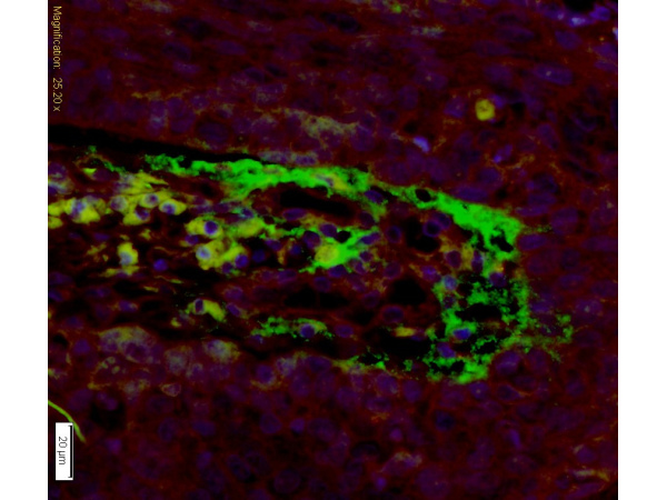 Formalin-fixed and paraffin embedded human laryngeal cancer tissue labeled with Anti-APOH Polyclonal Antibody, Unconjugated (bs-1570R) at 1:200 followed by conjugation to the secondary antibody, Goat Anti-Rabbit IgG, AF488 conjugated (bs-0295G-AF488), and DAPI staining Formalin-fixed and paraffin embedded human laryngeal cancer tissue labeled with Anti-APOH Polyclonal Antibody, Unconjugated (bs-1570R) at 1:200 followed by conjugation to the secondary antibody, Goat Anti-Rabbit IgG, AF488 conjugated (bs-0295G-AF488), and DAPI staining