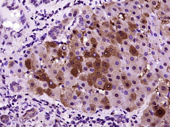 Paraformaldehyde-fixed, paraffin embedded Human liver; Antigen retrieval by boiling in sodium citrate buffer (pH6.0) for 15min; Block endogenous peroxidase by 3% hydrogen peroxide for 20 minutes; Blocking buffer (normal goat serum) at 37°C for 30min; Antibody incubation with CRP Polyclonal Antibody, Unconjugated (bs-0155R) at 1:400 overnight at 4°C, DAB staining.