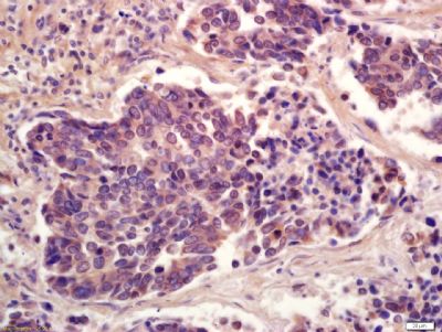 Paraformaldehyde-fixed, paraffin embedded Human lung carcinoma; Antigen retrieval by boiling in sodium citrate buffer(pH6) for 15 minutes; Block endogenous peroxidase by 3% hydrogen peroxide for 30 minutes; Blocking buffer (normal goat serum) at 37°C for 20 minutes; Antibody incubation with PPAR Gamma(ser273) Polyclonal Antibody, Unconjugated (bs-4888R) at 1:200 overnight at 4°C, followed by a conjugated secondary antibody and DAB staining.